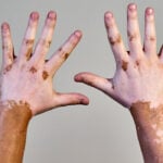 Vitiligo — how an inclusive environment makes a big difference